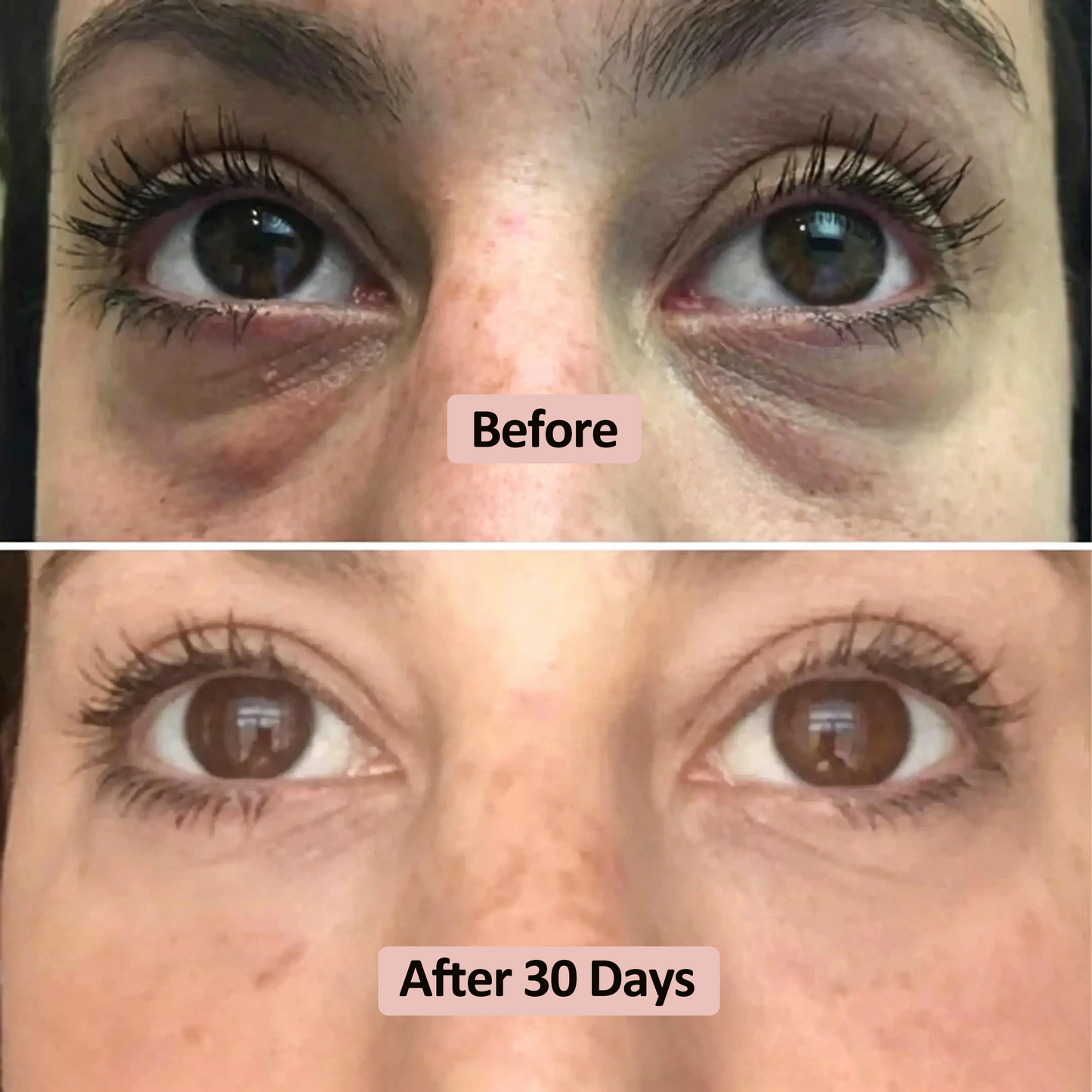 Saniviacn® Microneedle Under Eye Patch